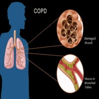 Štampa postera o hroničnoj opstruktivnoj plućnoj bolesti Monice Schroeder Science Source